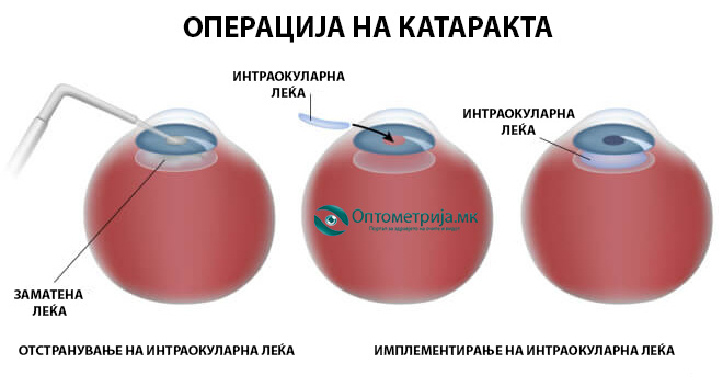 proces na operacija na katarakta, otstranuvanje na zamatenata intreokularna leka, i vbrizguvanje na nova vestacka intraokularna leka